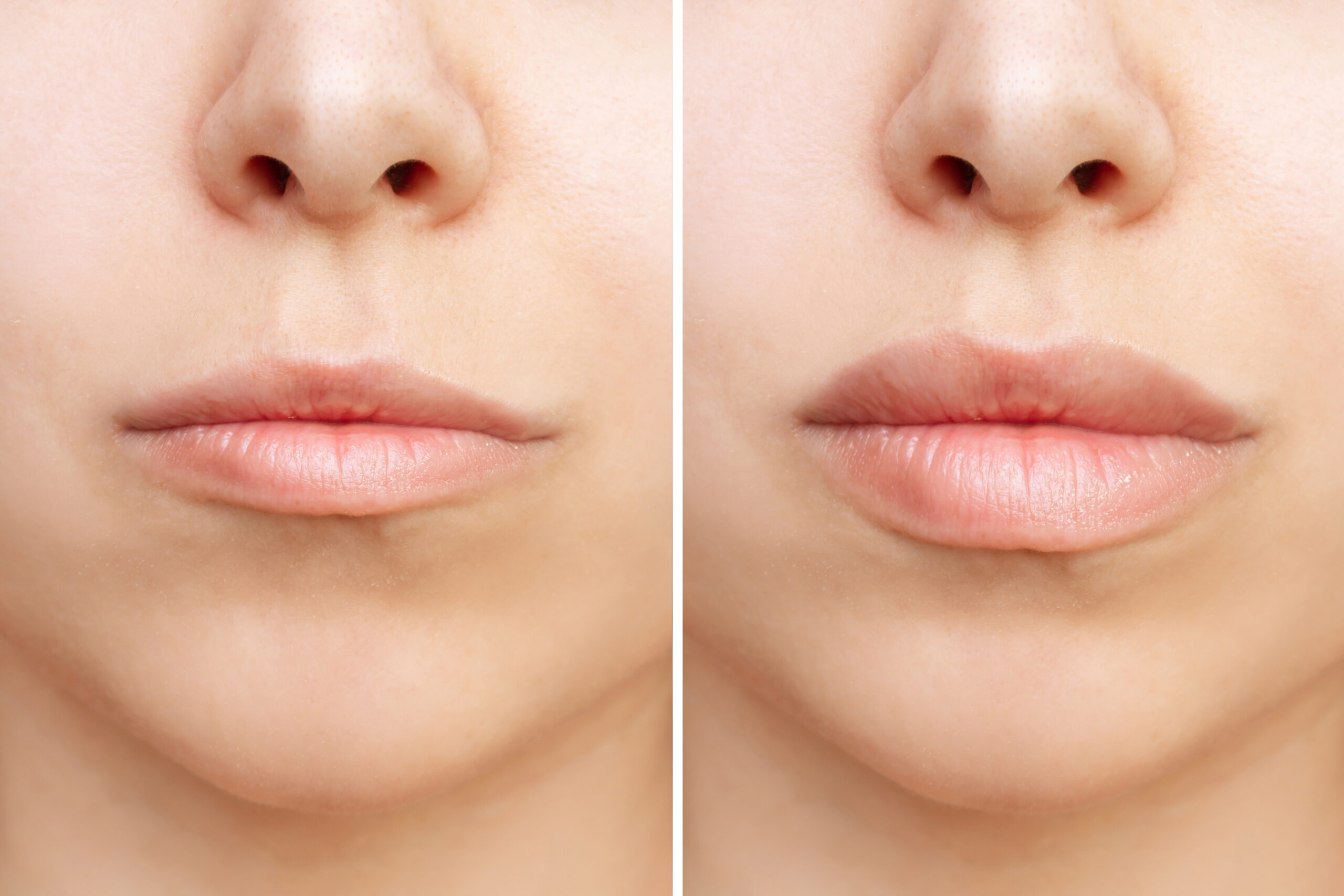 cropped-shot-young-woman-s-lower-part-face-with-lips-before-after-lip-enhancement