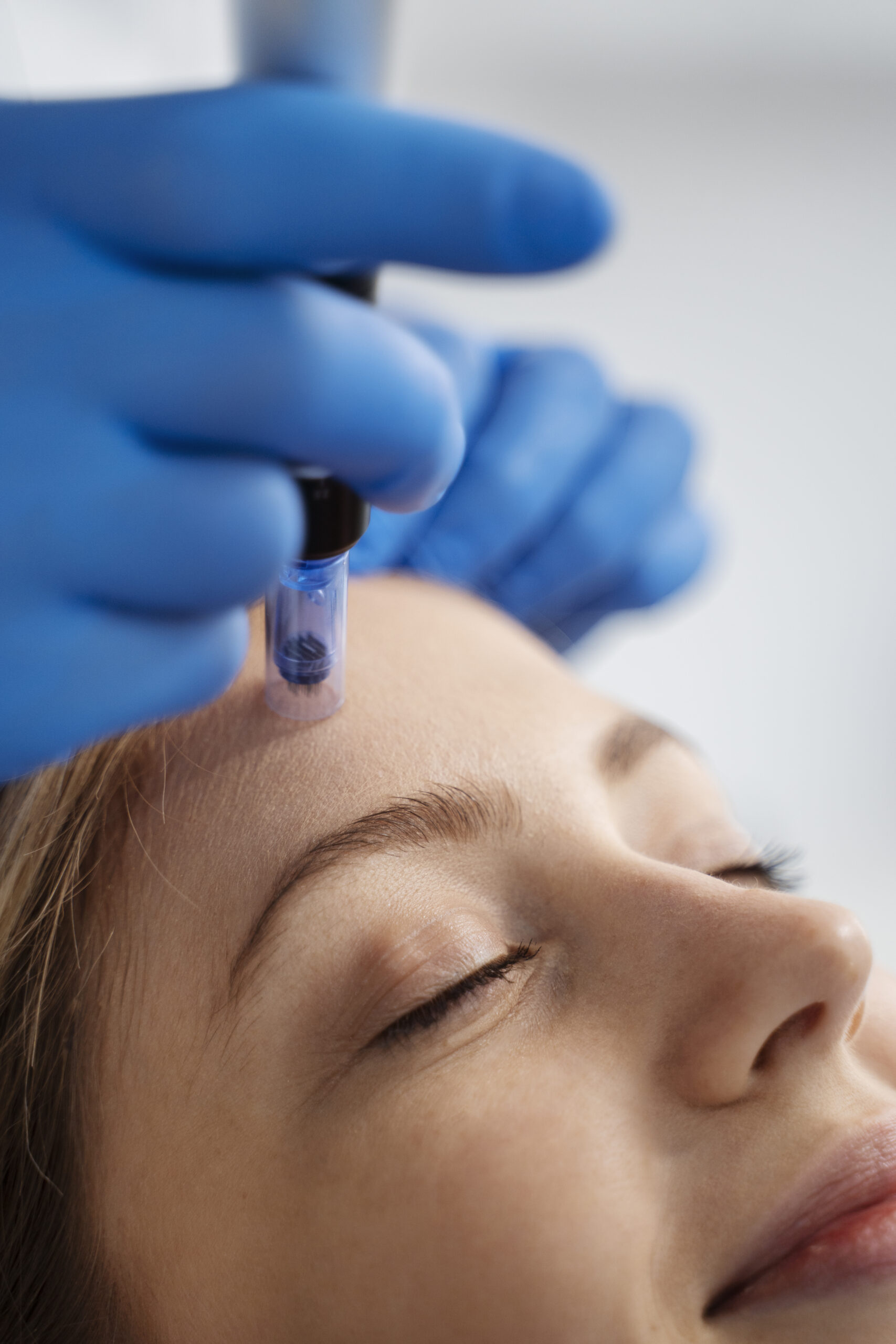patient-undergoing-microneedling-procedure